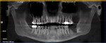 Fig 22. Postoperative panoramic radiograph. Note extraction of teeth Nos. 16, 66, 18, and 67. Coronectomy performed on tooth No. 17. Bone graft placed in tooth No. 18 site.