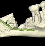 Fig 23. Postoperative CBCT, 3D reformation, with IAN represented, lingual plate digitally removed, tooth No. 17, lateral-lingual view. Note coronectomy of tooth No. 17, intimate proximity of the apices of tooth No. 17 to the IAN.