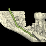 Fig 24. Postoperative CBCT, 3D reformation, with IAN represented, lingual plate digitally removed, tooth No. 17, anterior-to-posterior view. Note coronectomy of tooth No. 17, pulp chambers visualized, intimate proximity of the roots and remaining portion of tooth No. 17 to the IAN.