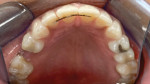 Fig 1. Occlusal view of maxillary arch, pretreatment.