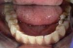 Fig 2. Occlusal view of mandibular arch, pretreatment.