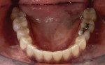 Fig 5 and Fig 6. Occlusal views of the maxillary (Fig 5) and mandibular (Fig 6) arches, post-treatment, demonstrating that spaces in both dentitions were closed and teeth were leveled and aligned.