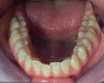 Fig 7. Pretreatment situation showing  mandibular anterior crowding.