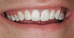Figure 1a  Initial full smile.