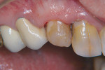 Figure 4  The tooth after restoration.