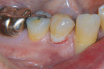 Figure 6  This lesion was also restored with Ketac Nano restorative.
