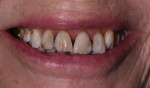 Preoperative close-up smile photograph and retracted right and left lateral close-up photographs. Note the areas of arrested cavities, dry mouth-related dental repercussions resulting from the patient’s history of radiation treatment, significant spacing issues, and discolored teeth.