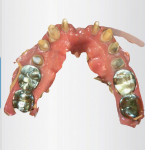 Views of the mandibular and maxillary digital impressions of the crown and bridge preparations, respectively.
