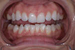 Pretreatment retracted facial view of the patient with teeth apart.