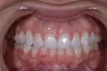 Retracted and lateral 1:2 magnification views of the patient after the completion of clear aligner therapy.