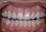 Retracted and lateral 1:2 magnification views of the patient after the completion of clear aligner therapy.