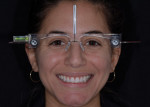 Full face smile and bite stick photographs of the patient with facial reference glasses were sent to the laboratory along with intraoral scans of both arches to communicate the dentofacial esthetic data and bite relationship.