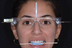 Full face smile and bite stick photographs of the patient with facial reference glasses were sent to the laboratory along with intraoral scans of both arches to communicate the dentofacial esthetic data and bite relationship.