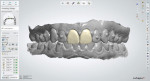 Software views of the minimally invasive veneers that were digitally designed by the laboratory for teeth Nos. 8 and 9.