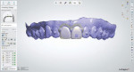 Software views of the minimally invasive veneers that were digitally designed by the laboratory for teeth Nos. 8 and 9.