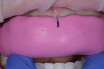 A self-curing temporary material was used with a laboratory provided putty matrix to create a facial reduction preparation guide.
