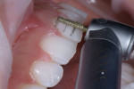 After depth cuts were made and marked with a graphite pencil, the surfaces of teeth Nos. 8 and 9 were reduced equally from the cervical third to the incisal third to a smooth finish.