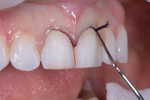 Size 0 and size 1 gingival retraction cords were inserted into the gingival sulcus prior to taking the final impression.