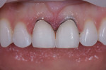Size 0 and size 1 gingival retraction cords were inserted into the gingival sulcus prior to taking the final impression.