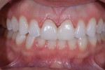After patient approval of the shade and shape of the temporary restorations, a close-up retracted photograph was taken to communicate the information to the laboratory.