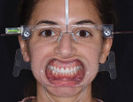 Full face smile and retracted photographs of the provisionalized patient wearing facial reference glasses were taken to communicate the correct midline and shade of the final veneers to the laboratory.