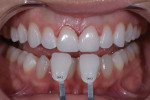 A retracted 1:2 magnification photograph of the seated temporary restorations and a retracted shade tab photograph were taken to communicate the shade of the adjacent teeth to the laboratory.