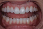Smile, left lateral smile, and retracted views of the final minimally invasive lithium disilicate veneers.
