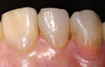 Beautifil II Gingiva is a nano-hybrid, universal composite that comes in five unique shades that can be blended and layered to match the gingival shades of patients of all ethnicities.
