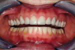 Figure 4  The crowns seated in the mouth. The patient selected a lighter shade and plans to bleach the mandibular teeth to match.