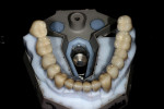 Figure 5   5 PFM crowns, teeth Nos. 18 to 31 on a Lava C.O.S. SLA model illustrate the point that those changing from traditional impressions to digital are not limited to only CAD-designed, all- ceramic materials.