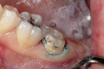 Figure 6  Proper cord pack provides good tissue retraction and an unobstructed view of the margin.
