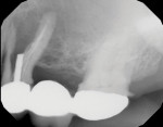 Preoperative digital periapical radiograph showing a conventional bridge with a severe vertical fracture of the bicuspid abutment resulting in bone loss. The negative symptoms experienced by the patient included swelling and discomfort.