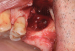 The tooth was removed in sections, and the tissue was reflected, exposing a large boney defect with significant granulation tissue that had to be curetted from the site.