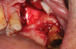 The Schneiderian membrane was exposed but not perforated. A piece of the alloplastic calcium apatite graft material was carefully condensed to the floor of the sinus with the intention of elevating it and protecting the sinus cavity from the placement of additional graft material.