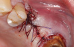 The surgical site was sutured with resorbable Vicryl sutures, which were removed after 7 days. Note that there is an adequate band of attached gingiva available, which is a requirement for dental implant placement.