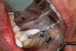 Figure 8  Isolite and cotton roll place in the mouth prior to scanning.