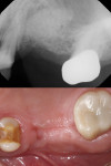 A digital periapical radiograph acquired 1-week postoperatively illustrates the opacity of the allograph material and the controlled placement of the graft. The ridge height was evaluated both radiographically and visually.