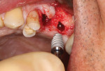After the second osteotomy was prepared, the implant was placed. The implants should be at least 3 mm apart because there is no blood supply available from the periodontal ligaments.