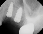A postoperative radiograph was acquired and evaluated, and the tissue reflection was sutured closed. The implants will be allowed to integrate for an additional 4 months prior to uncovering and impression making for single-unit implant retained restorations.