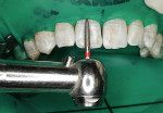 Figure 3  Use of a fine (50 µm) flame-shaped finishing diamond to macroabrade facial surfaces of maxillary teeth.