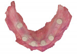 Fig 5. The optical scan of the mandibular arch was processed and sent to the laboratory. Scan bodies were removed from the abutments and set aside.