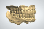 Fig 9. The opposing arch was optically scanned, and an optical scan of the teeth in occlusion was captured.