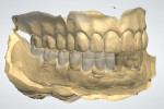 Fig 10. A technician superimposed the scan of the arch with scan bodies onto the scan of the relined denture using a dental laboratory software.