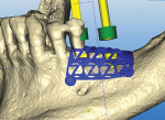 Fig 2. CBCT of mandible showing the mesh design.
