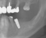 Fig 10. Radiograph of the implant in place.