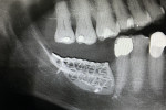 Fig 17. Radiograph after placement of the mesh showing nice seating of the mesh.