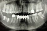 Fig 21. Radiograph after implant placement.