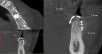 Fig 22. CBCT showing different gains of bone width before mesh removal, patient 1.
