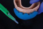 Fig 7. Silicone indexes used to make intraoral mock-up.