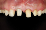 Fig 9. Minimally invasive teeth preparation.